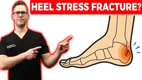 stress fracture test for heel